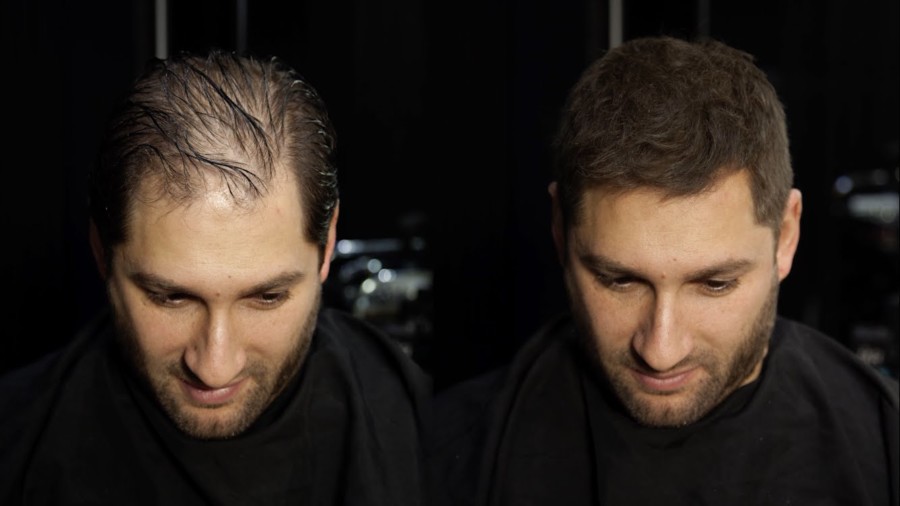 How To Conceal Thinning Hair Without Having A Hair Transplant